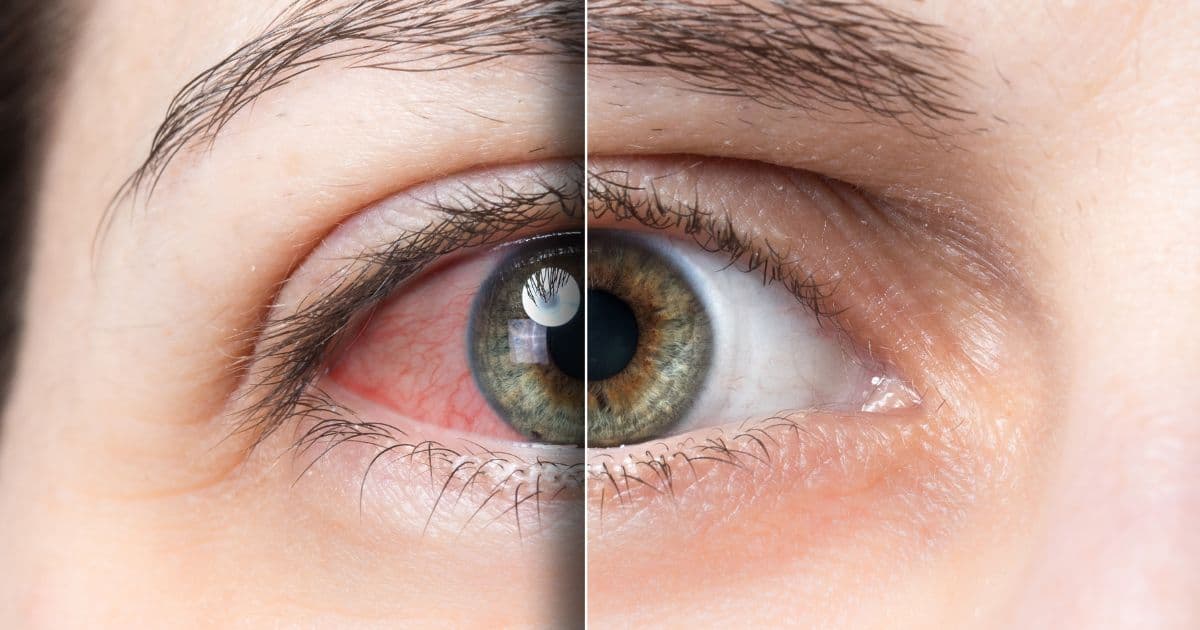 Alergije oka- uzroci, simptomi i liječenje